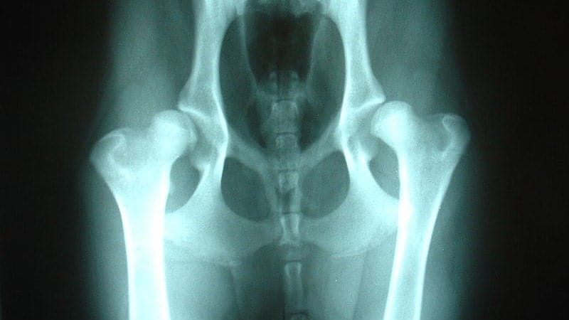 Bilateral hip dysplasia