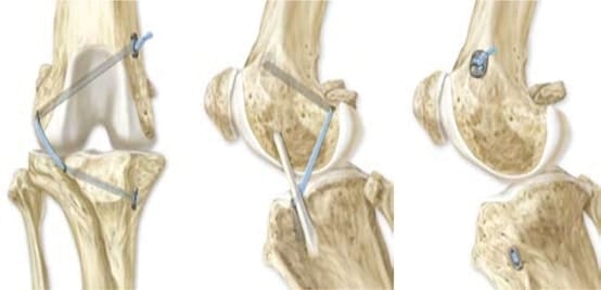 Cranial Cruciate Ligament Rupture